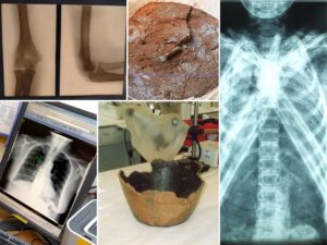 Montage photograph of x-ray images